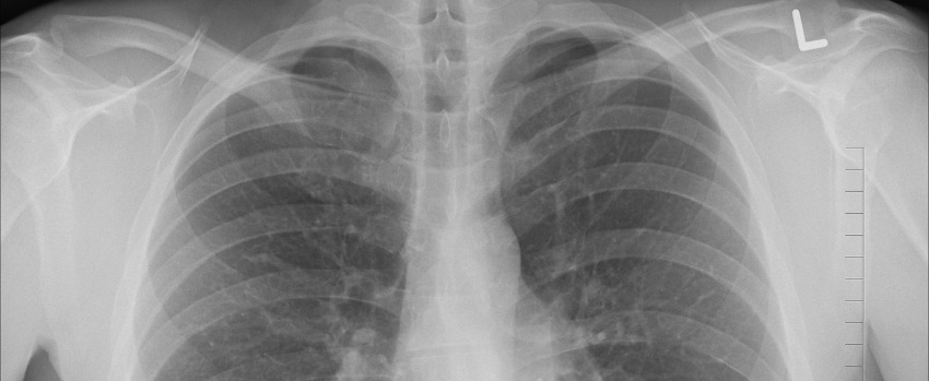 здоровые лёгкие на рентгеновском снимке