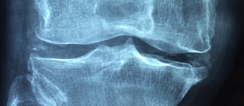 коленный сустав на рентгене
