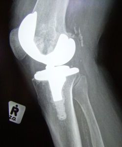 Рентгеновский снимок сустава